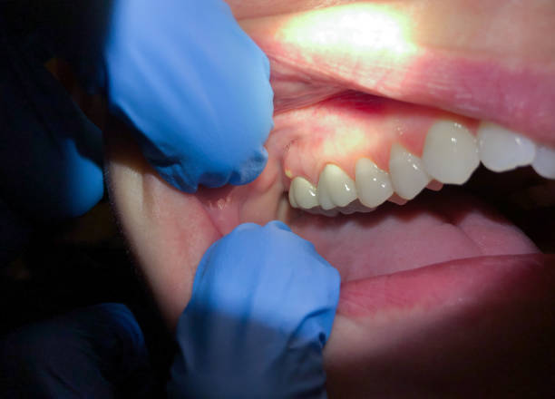 Best Emergency Treatment for Oral Infections in Rden City, GA